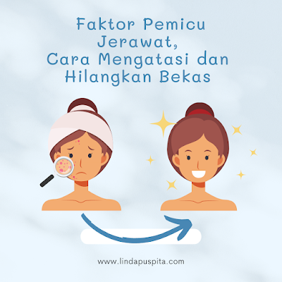 faktor-pemicu-jerawat-cara-mengatasi-dan-hilangkan-bekas