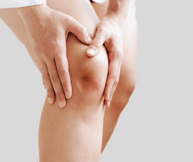 How to get rid of a bruise in adults at home