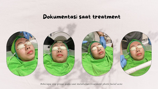 treatment photo facial acne di zap
