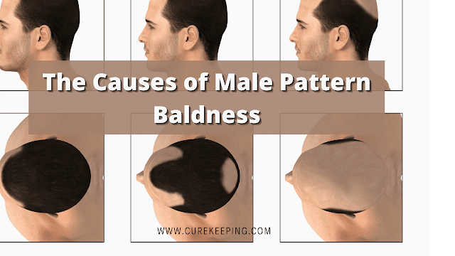 The Causes of Male Pattern Baldness