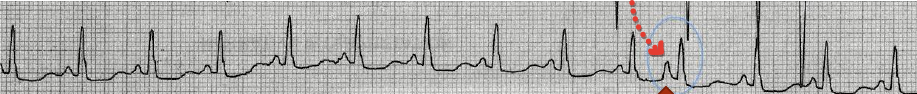 prematüre-atriyal-kompleks-ekg-degerlendirme-1