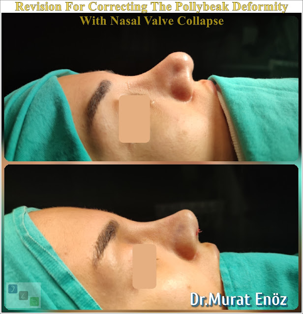 Nasal valve collapse, Pollybeak Deformity, Polly Beak Nose Deformity,