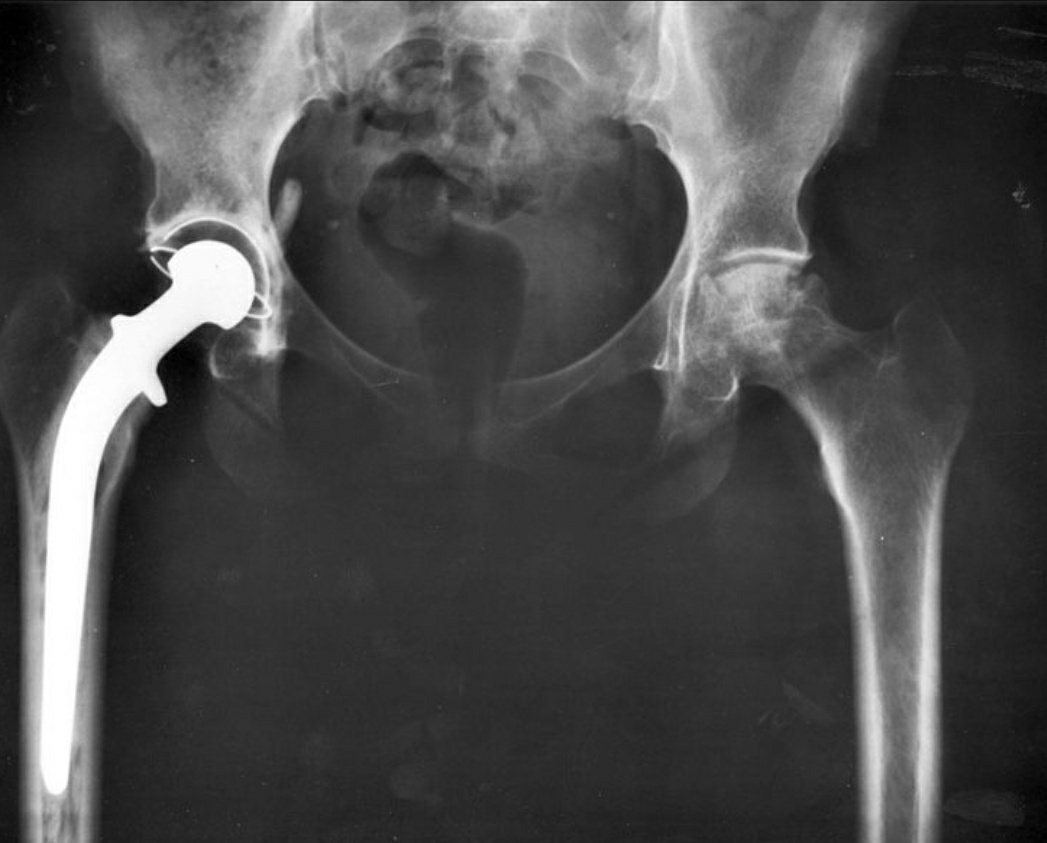 Total Hip Replacement - The first six weeks