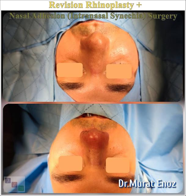 revision rhinoplasty + nasal adhesion removal surgery + septoplasty + nasal bone spur excision