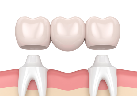 dán sứ veneers có bền không, da su veneers co ben khong