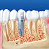 Cấy răng implant bao nhiêu tiền