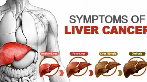 LIVER CANCER AND TREATMENT