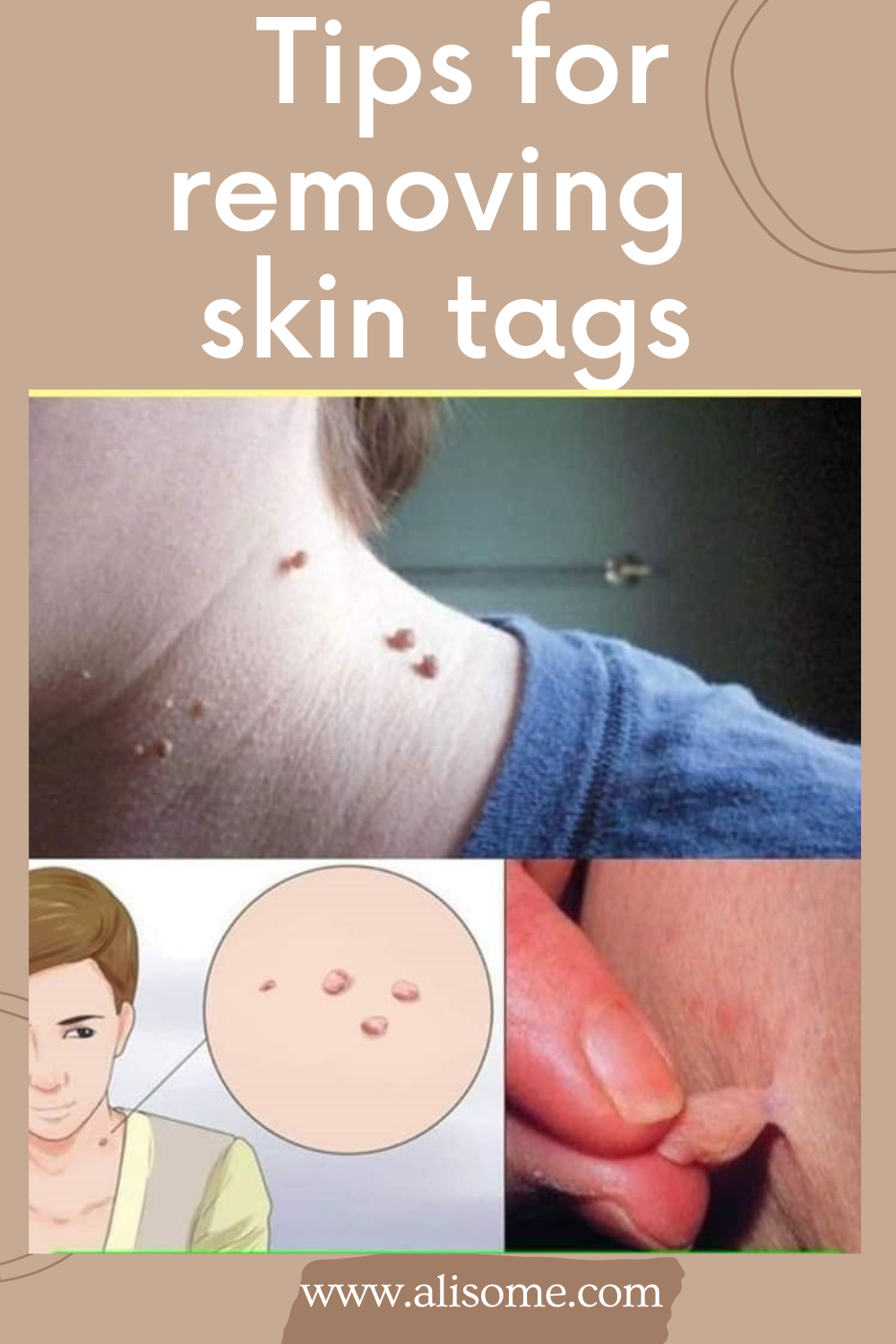 Tips for removing skin tags