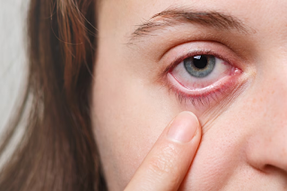 a women showing eye flu to phoenix eye surgeon