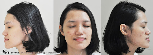 After Avoskin Miraculous Acne Solution Spot Treatment Result
