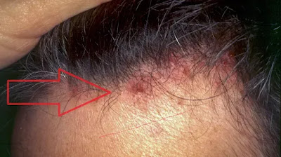 causes of folliculitis,causes of fungal acne,pseudofolliculitis barbae symptoms,infected hair follicle treatment,hot tub folliculitis symptoms,scalp folliculitis causes,scalp folliculitis hair loss reversible,scalp folliculitis symptoms,hot tub rash cause, yeast infection folliculitis,pityrosporum folliculitis causes,pityrosporum folliculitis symptoms,folliculitis is caused by,infectious folliculitis,folliculitis caused by,bacterial infection of hair follicles,malassezia folliculitis causes ,