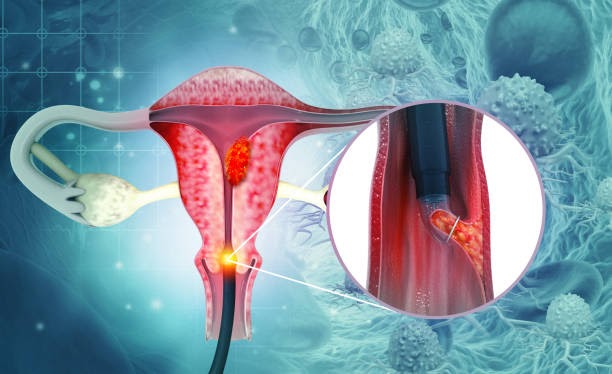 Fallopian Tube Cancer Market By Product, Application, Region, And Segment (2021-2027)