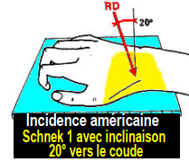 scaphoid bone in hand,scaphoid fracture hand,scaphoid fracture management,scaphoid injury,scaphoid fracture orthobullets,best brace for scaphoid fracture,scaphoid pain treatment,scaphoid pain relief,scaphoid fracture splint type,scaphoid brace