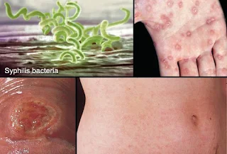 Effect of calamine lotion on scabies infection