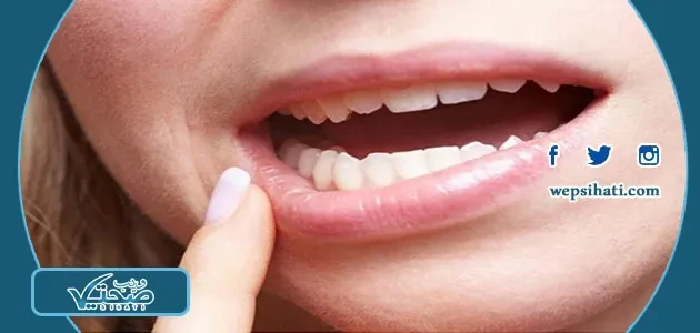 الفطريات بالفم : أسباب أعراض علاجه وطرق التخلص منه