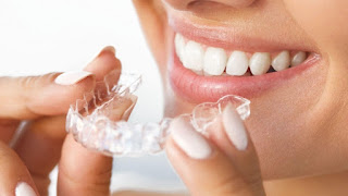 Invisalign là gì-1