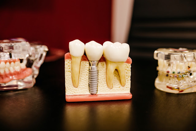 ما هي أهمية زراعة الأسنان وكيف تتم هذه العملية؟