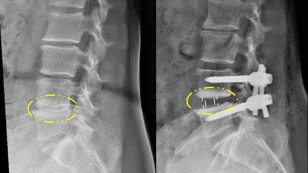 ▲蕭女士接受新式脊椎微創手術（右），撐開椎間盤空間，不再壓迫神經。（圖／彰化醫院提供）