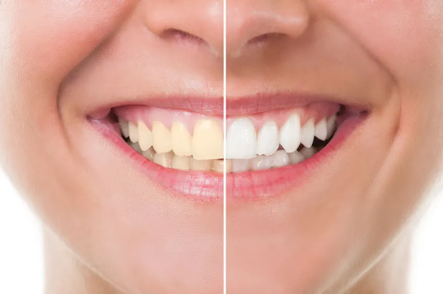 How To Make Your Teeth White At Home