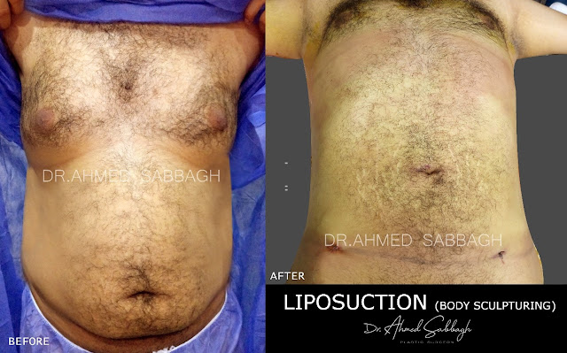 شفط دهون البطن -  Dr. Ahmed El Sabbagh - Plastic Surgeon د.أحمد الصباغ - جراح تجميل