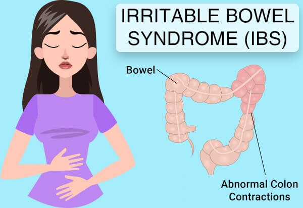 IBS：症状、原因、診断、トリガー、および治療