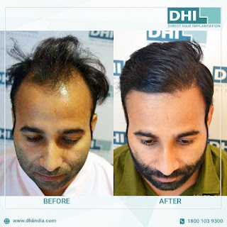 Hair Transplant Clinic in Chennai