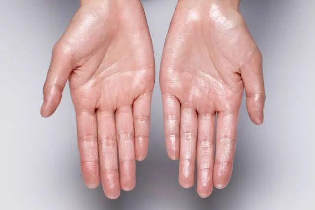 Treatment of sweating hands the 2 Medical and Natural Methods
