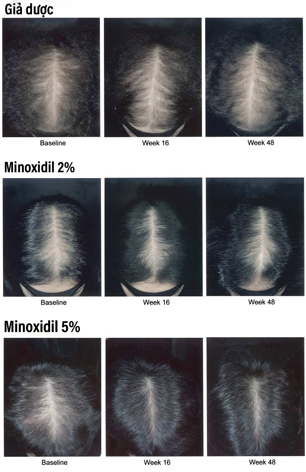 Tác dụng của minoxidil 2% và 5% so với giả dược.