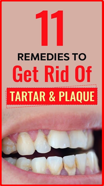 11 Home Remedies To Get Rid Of Tartar and Plaque On Teeth
