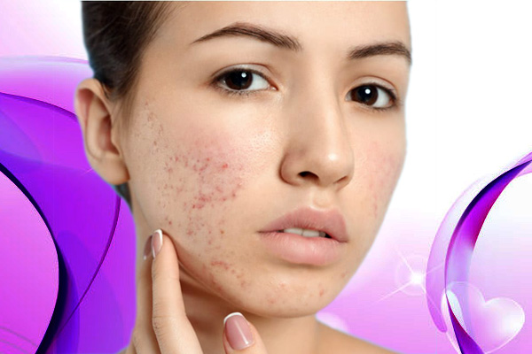 Acne Care for Adults