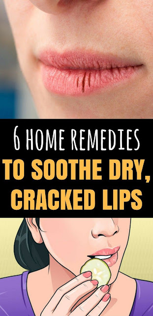 Here Are 6 Home Remedies To Soothe Dry Cracked Lips