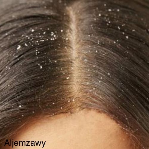 Get rid of the dandruff that appears after hair protein