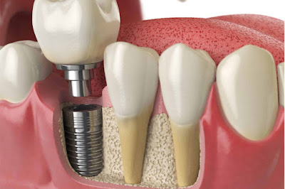 Quy trình cấy ghép implant như thế nào? 2