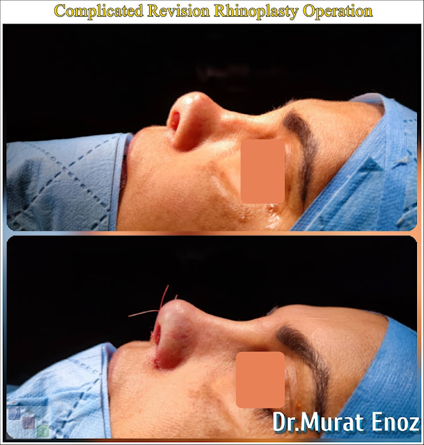 Complicated Revision Rhinoplasty in Istanbul, revision nose job,Overreducted Nose Hump, Asymmetrical Nostrils, Asymmetrical Nose Bone, Hanging Columella