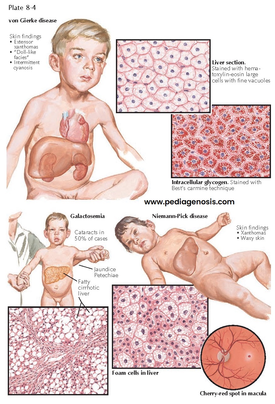 SELECTED METABOLIC DISEASES WITH SKIN FINDINGS