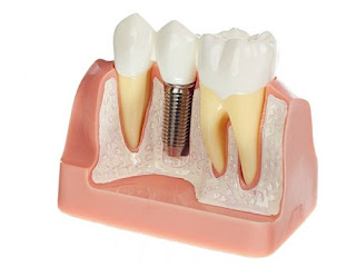 Quy trình cấy ghép răng implant-1
