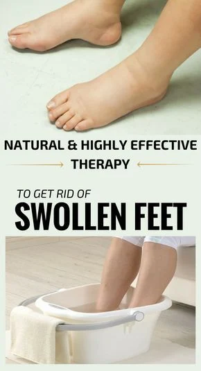 Solutions For Combating Swollen Feet With Natural Remedies