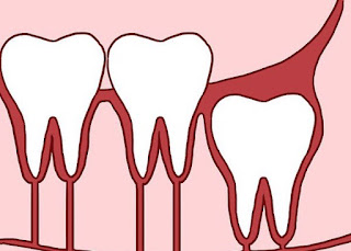 Vì sao nên giữ lại răng khôn mọc thẳng?-1