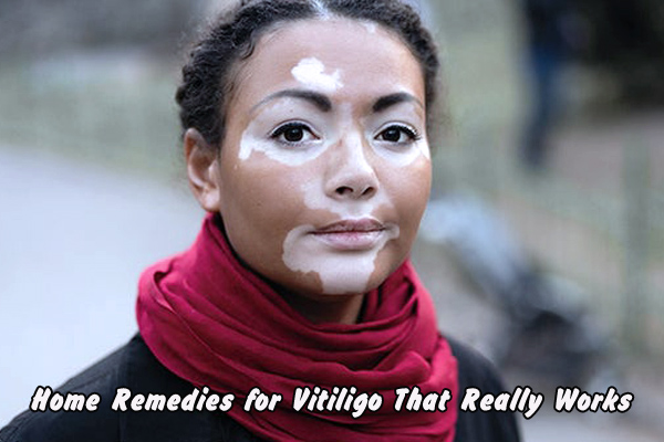 Home Remedies for Vitiligo That Really Works