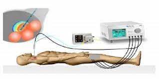 Radio Frequency Ablation Device