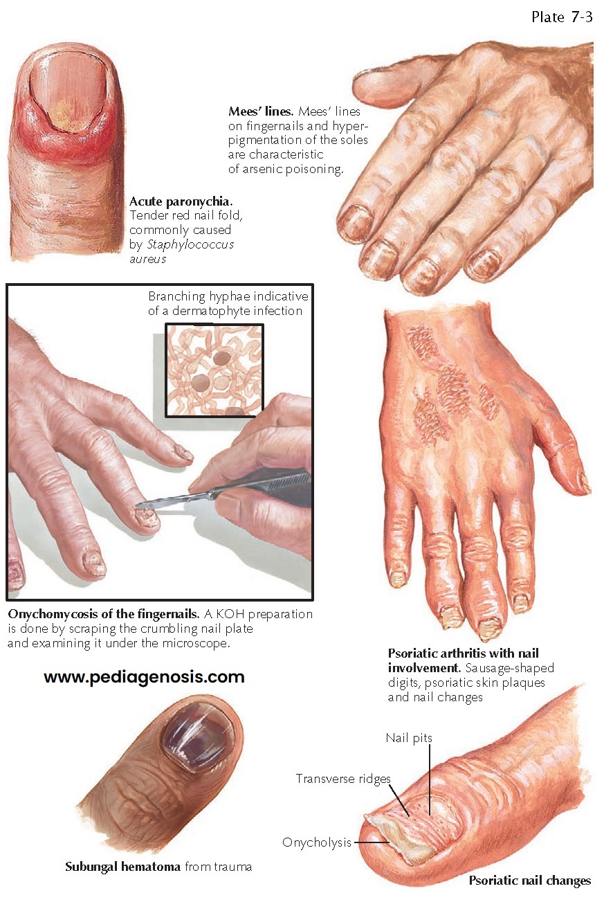 COMMON FINGERNAIL DISORDERS