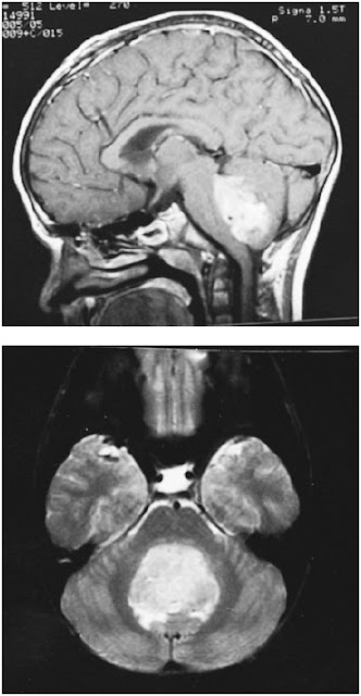 MRI in the sagittal and axial