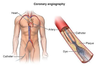 What is Angiography and Coronary Angiography