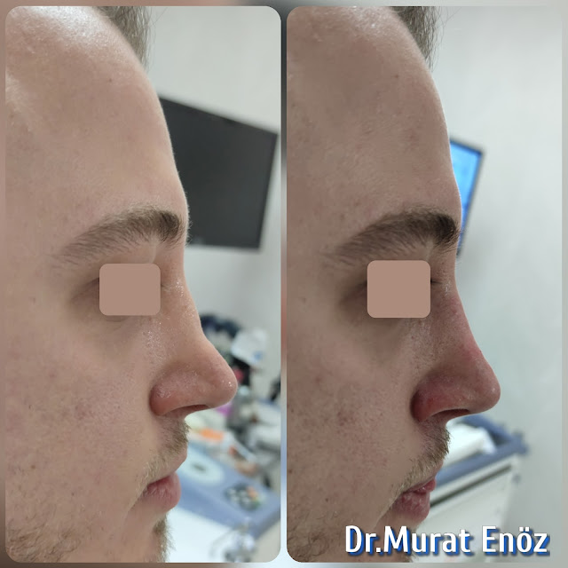 Cost of non-surgical rhinoplasty in Istanbul,Nose filler injection cost in Turkey,Cost of non-surgical nose job in Istanbul,Cost of non surgical nose job with filler in Istanbul,