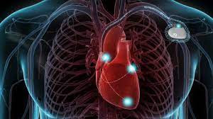 Implantable Cardioverter-Defibrillators