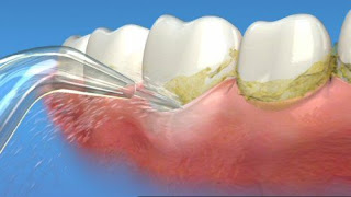 Quy trình cạo vôi răng tại nha khoa-1