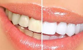 Quy trình tẩy trắng răng tại nha khoa-1