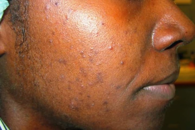 Ance-(skin disease) 