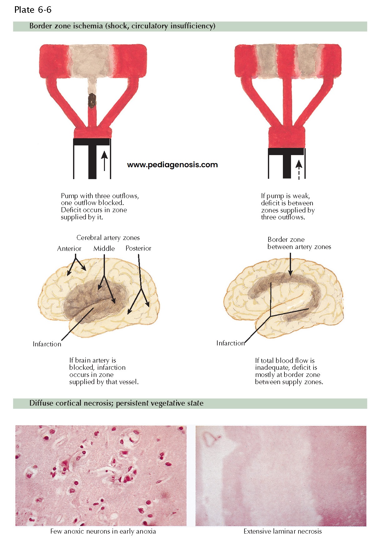 Hypoxic-Ischemic Brain Damage