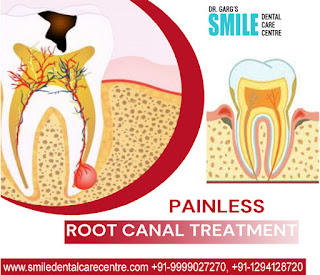 Painless Root Canal Treatment In Faridabad
